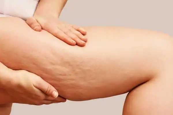 Image of woman showing leg with cellulite Sunderland