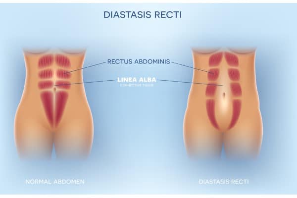 What Non-Surgical Options Are Available for Diastasis Recti Sunderland?