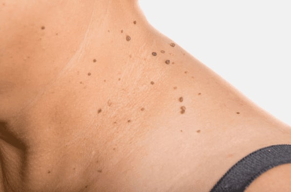 Are you looking for easy skin tag removal Sunderland - then contact Spire today!