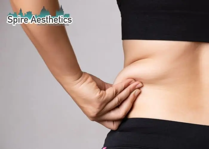 Image of woman pinching fat on their hips Sunderland. Fat Freezing treatment