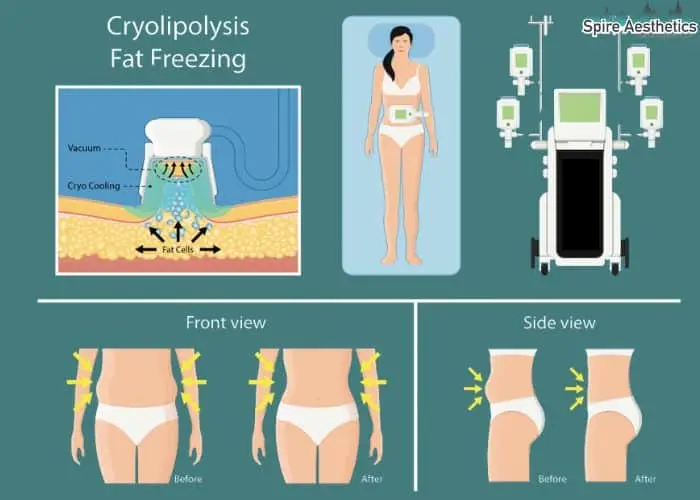 Fat freezing treatment Sunderland benefits for competitions to remove stubborn fat deposits.