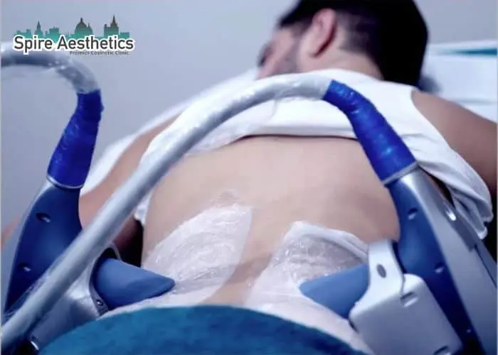 Man having fat freezing treatment done on love handles before a competitions Sunderland to create a sculpted look.
