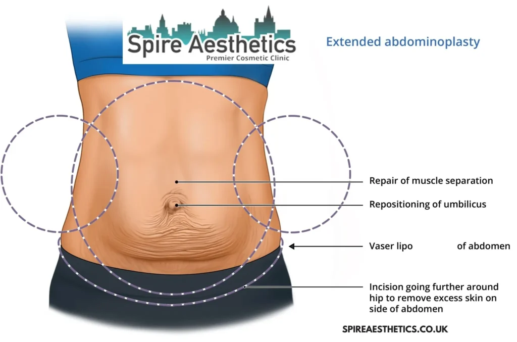 Understanding Loose Skin After Gastric Band Sunderland Surgery and HIFU Treatment