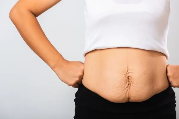 Image of a woman's stomach after weight loss with sagging skin following a gastric band Sunderland