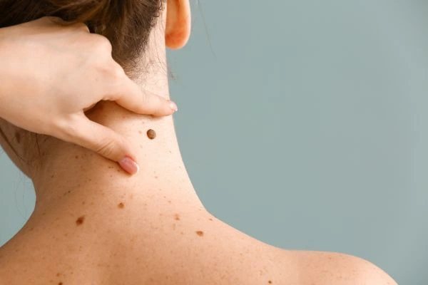 skin blemish removal Sunderland treatment