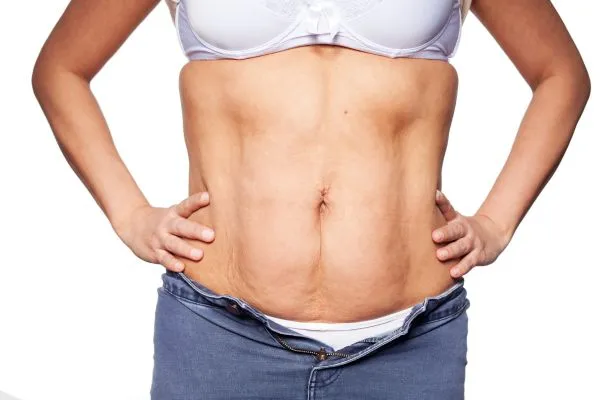 sagging skin on woman's stomach after weight loss injections Sunderland
