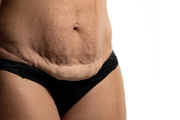 Image of womans stomach after weight loss injections Sunderland showing saggy skin